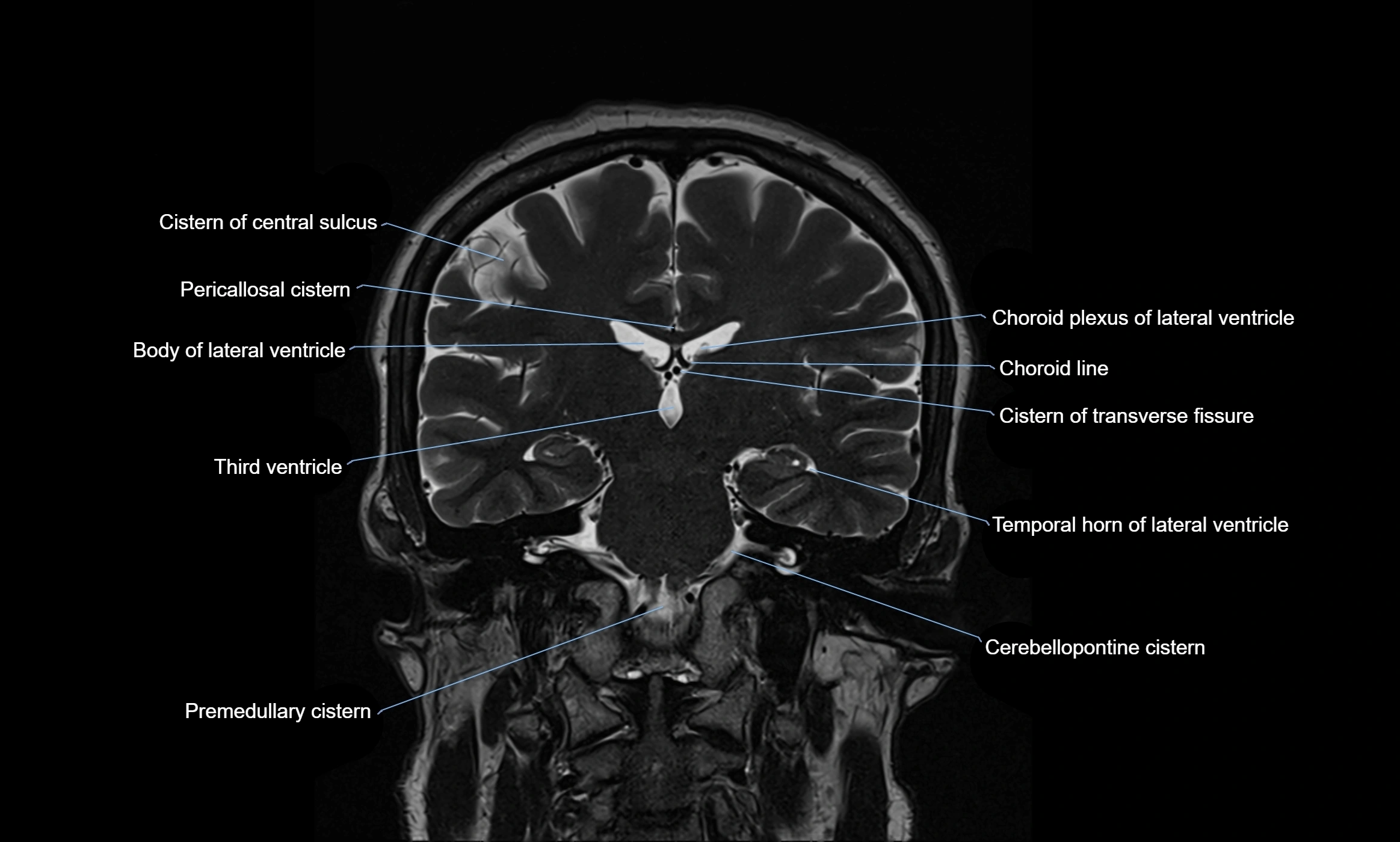 Brain cisterns  and ventricles coronal anatomy 3T MRI image-img-00001-00033.webp